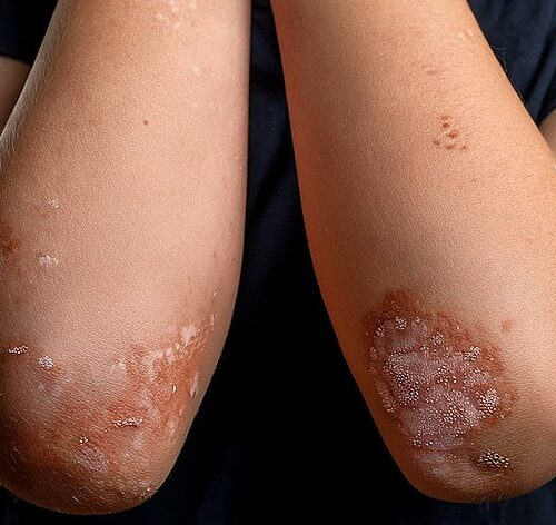 29 октября – Всемирный день псориаза