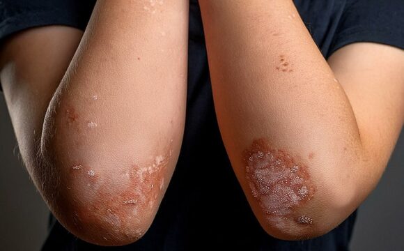 29 октября – Всемирный день псориаза